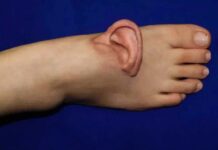 Inédito: médicos chineses costuram orelha no pé e a mentém viva